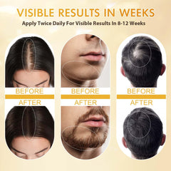 Minoxidil for Men and Women, Hair Growth Biotin Serum with Batana and Rosemary for Hair Beard Regrowth Treatments Extra Strength Hair Loss Solution, Clinically Proven to Regrow Thicker Ifelshop